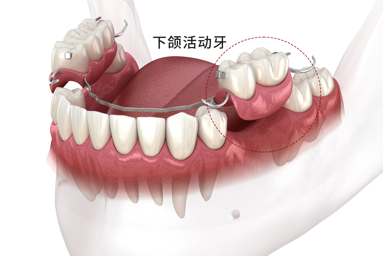 下颌活动牙图片（下颌活动牙设计）
