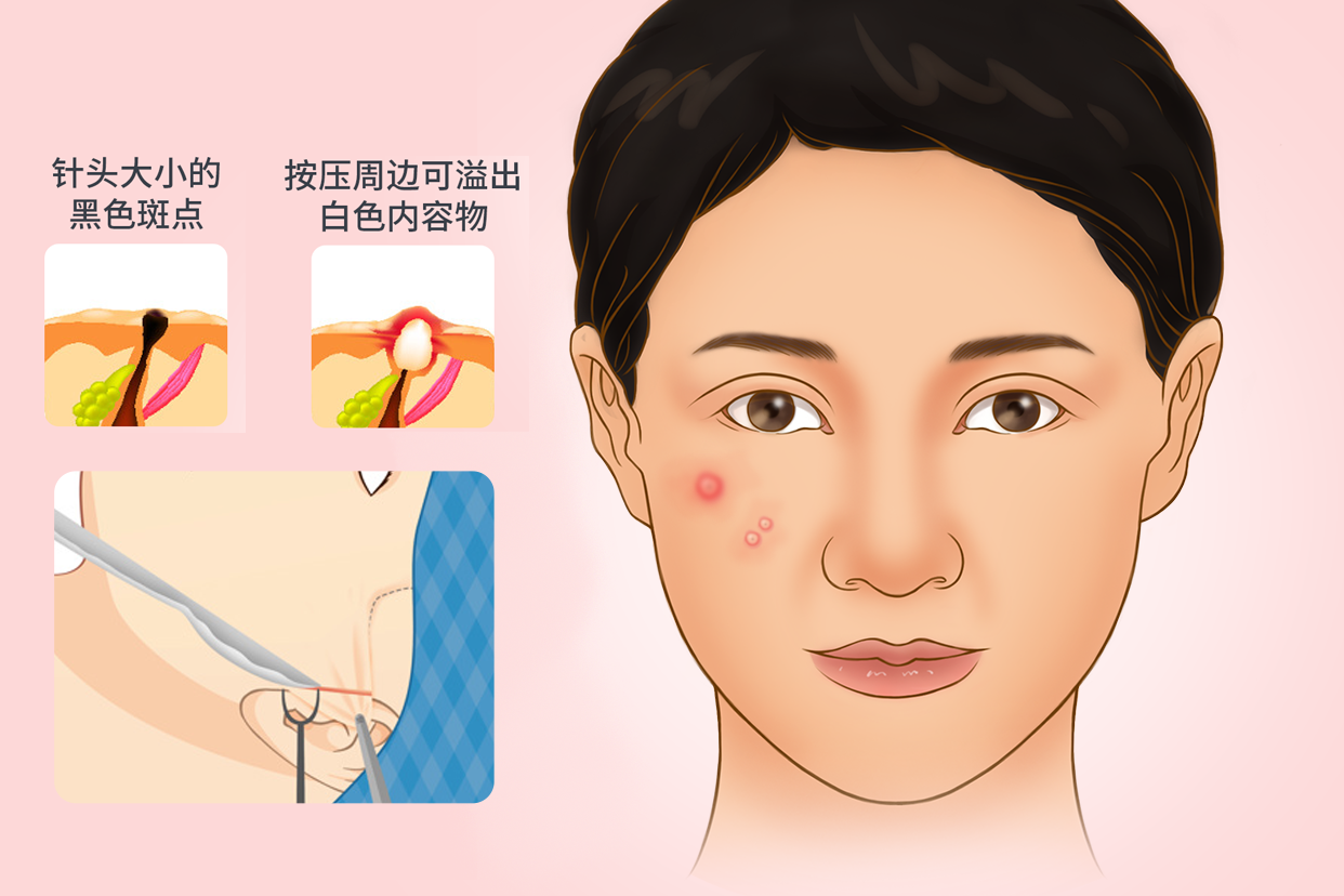 胃食管反流病白痰不斷測試-優(yōu)化