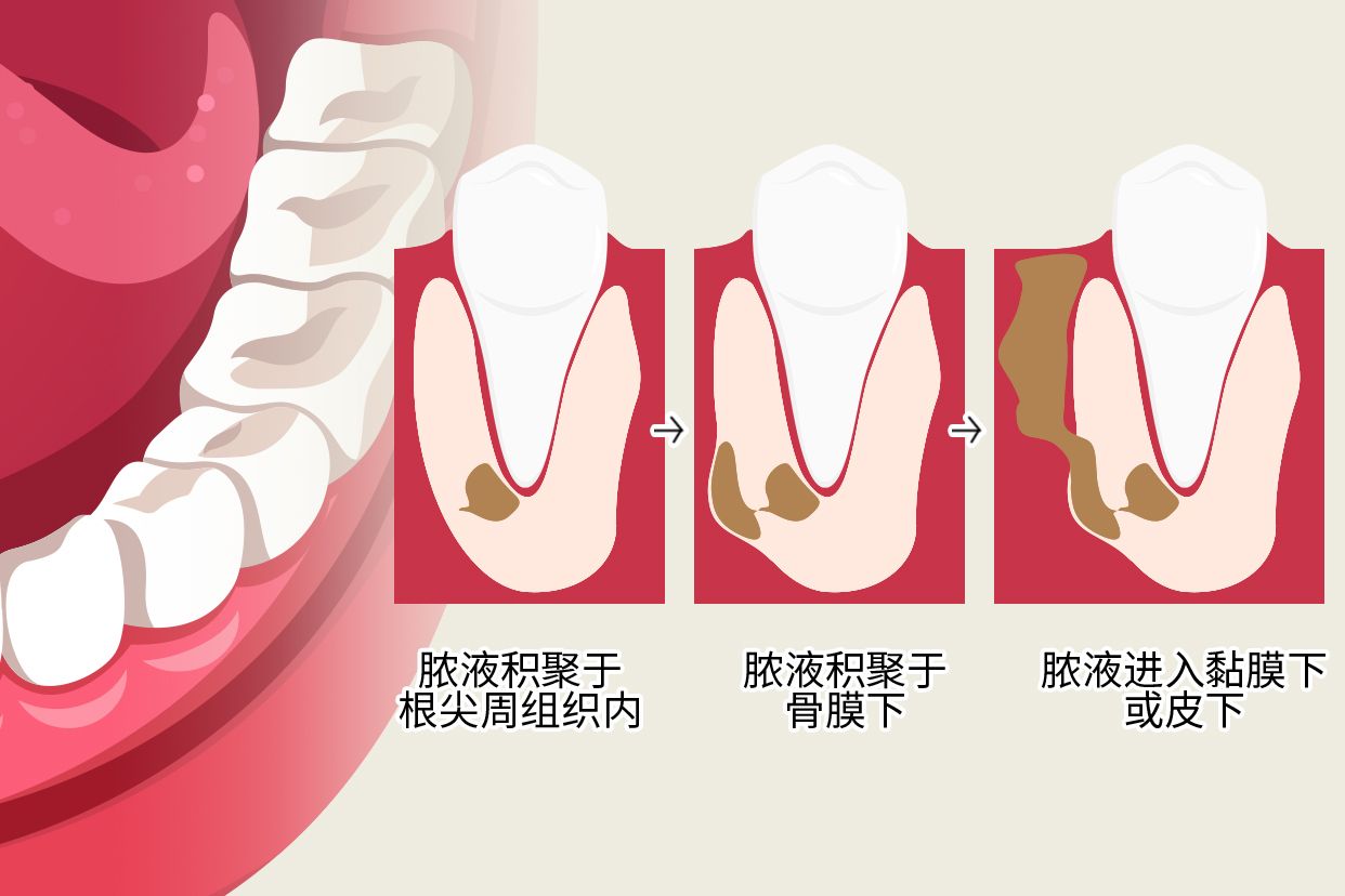 根尖周炎圖片全景牙圖