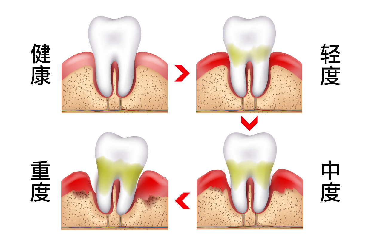 牙周輕中重度前后圖片