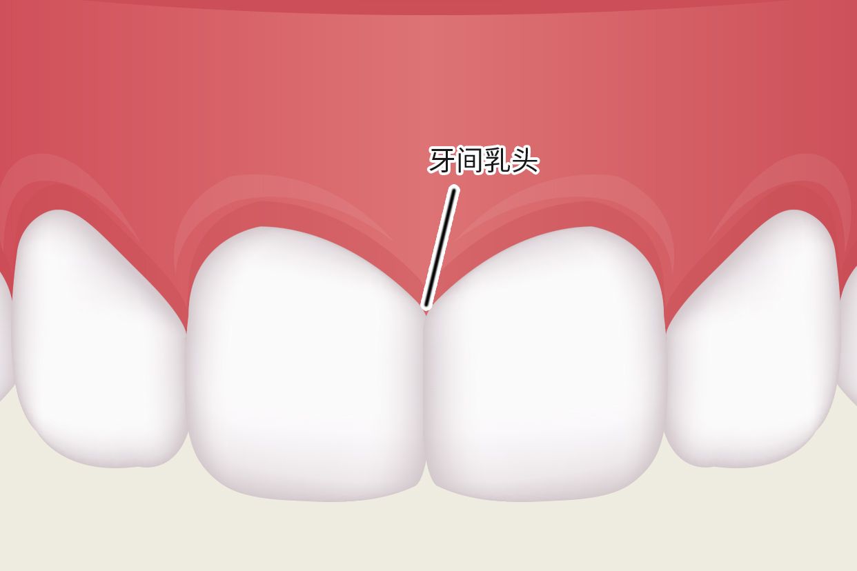 牙齦乳頭圖片