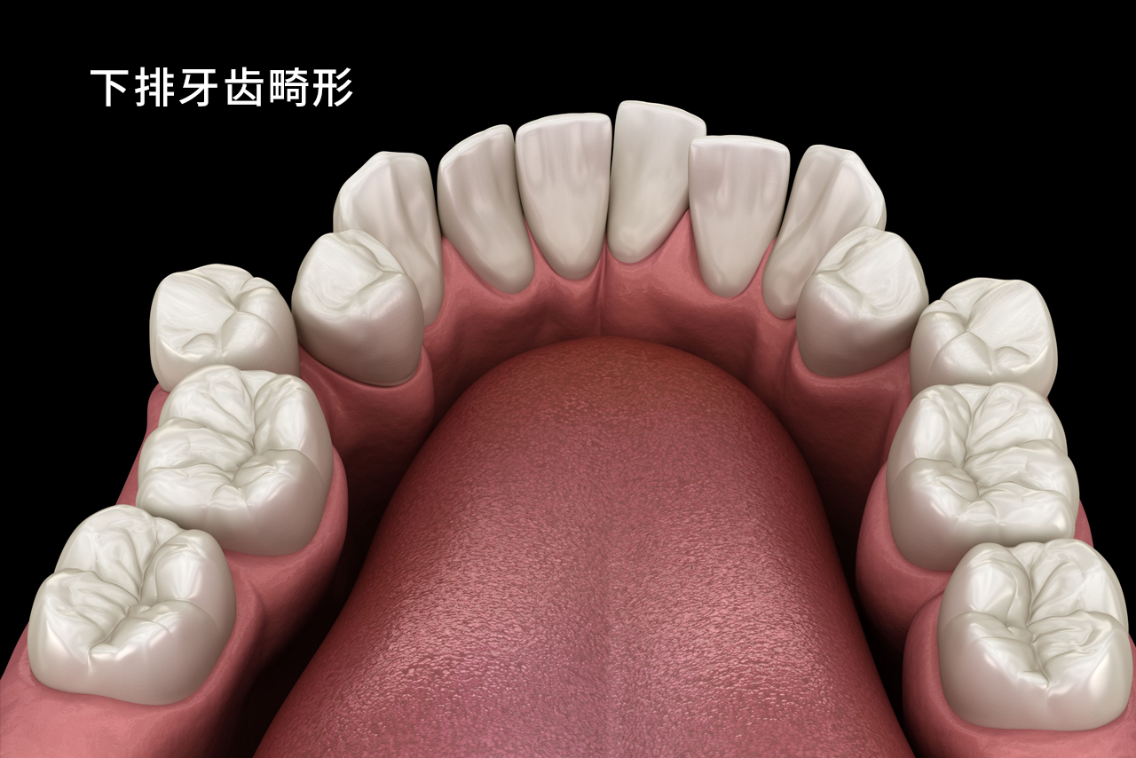 下排牙齒畸形圖