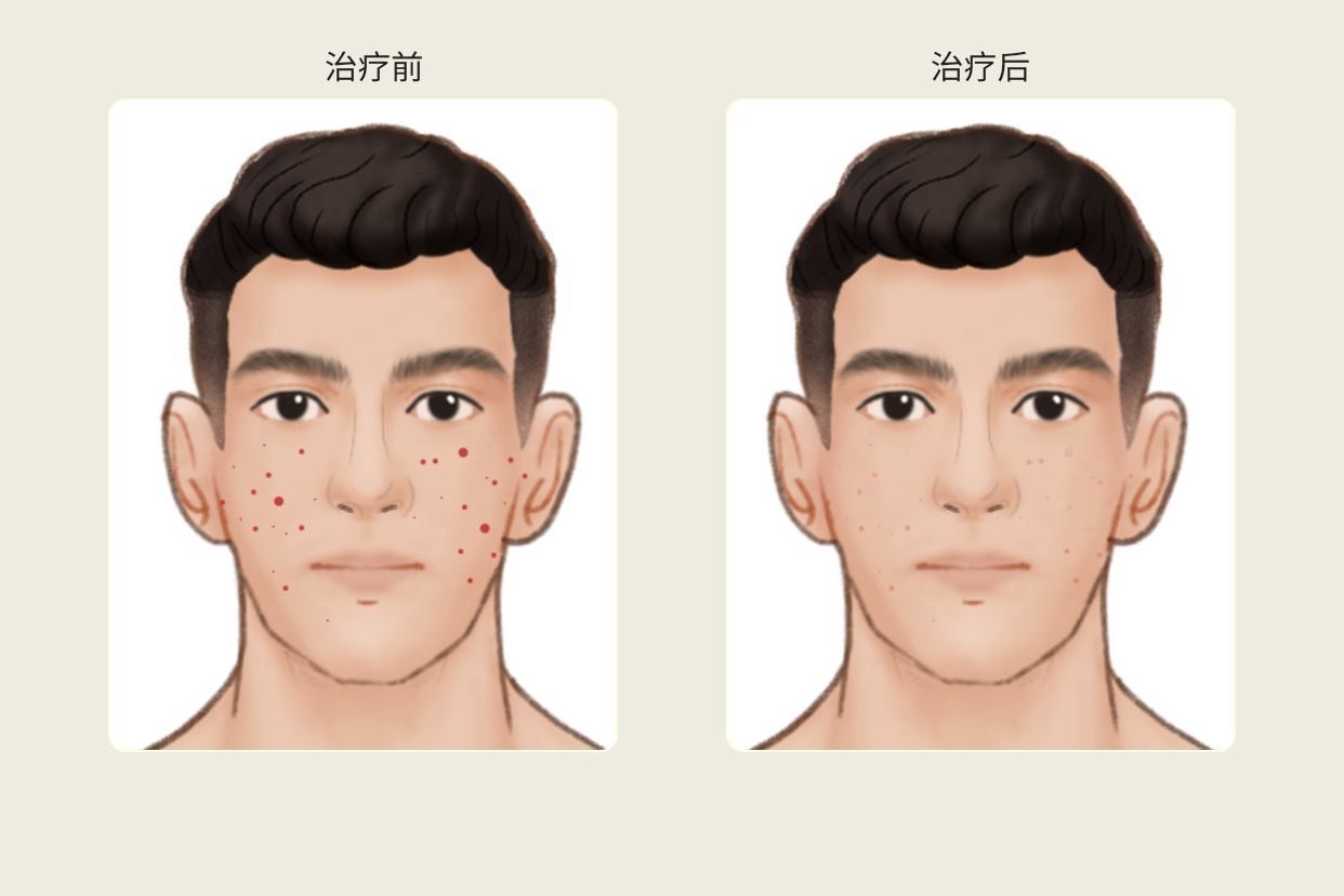 脉冲染料激光595掉痂后图