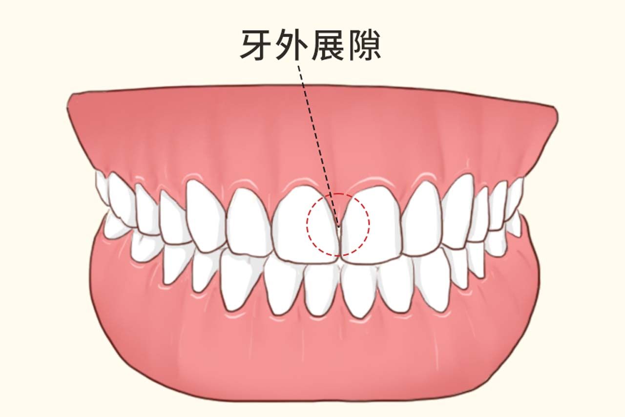 牙外展隙图解