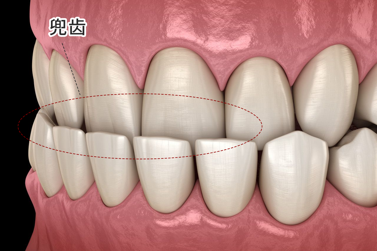 輕微兜齒圖片