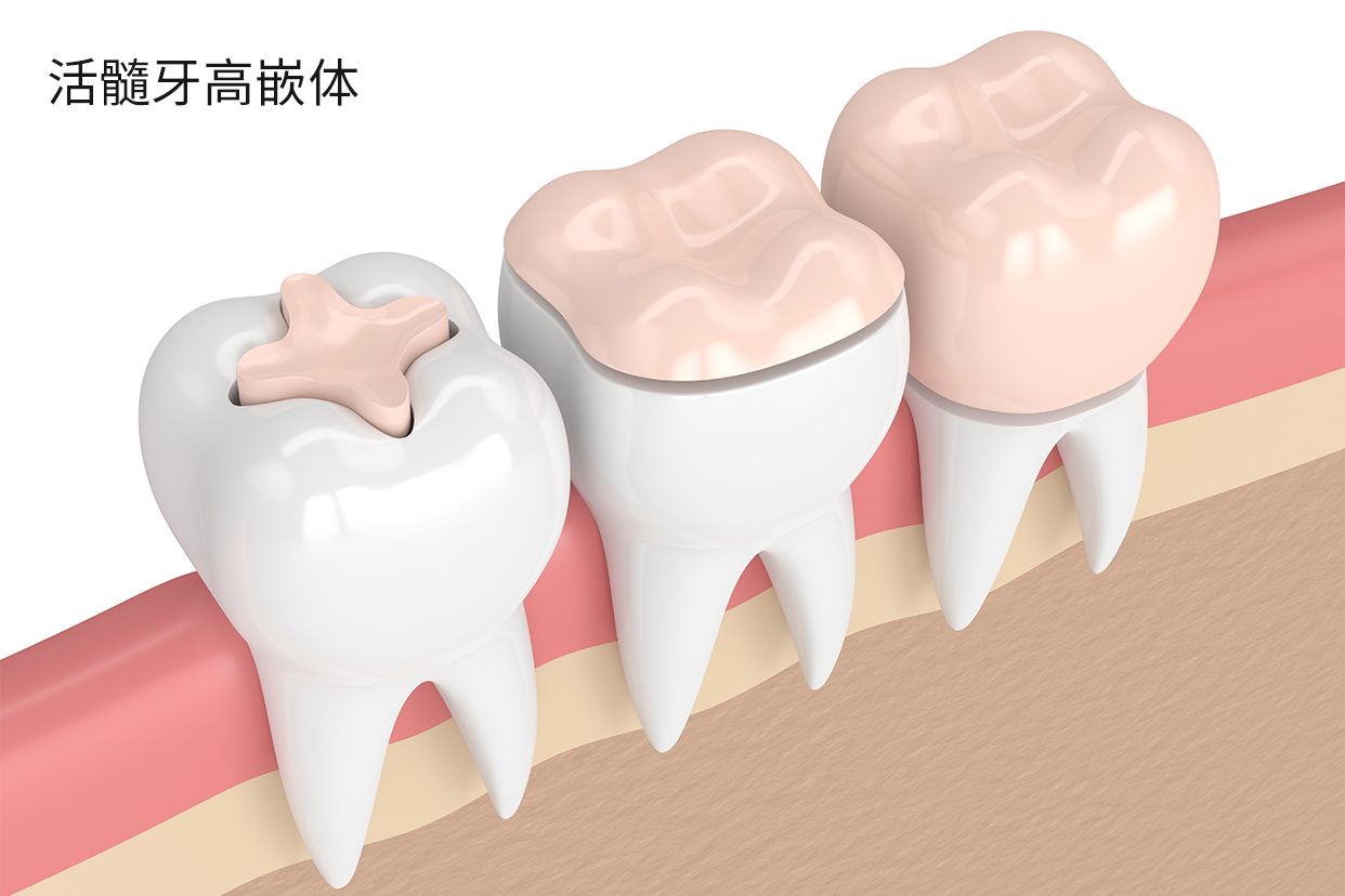 活髓牙高嵌體圖片