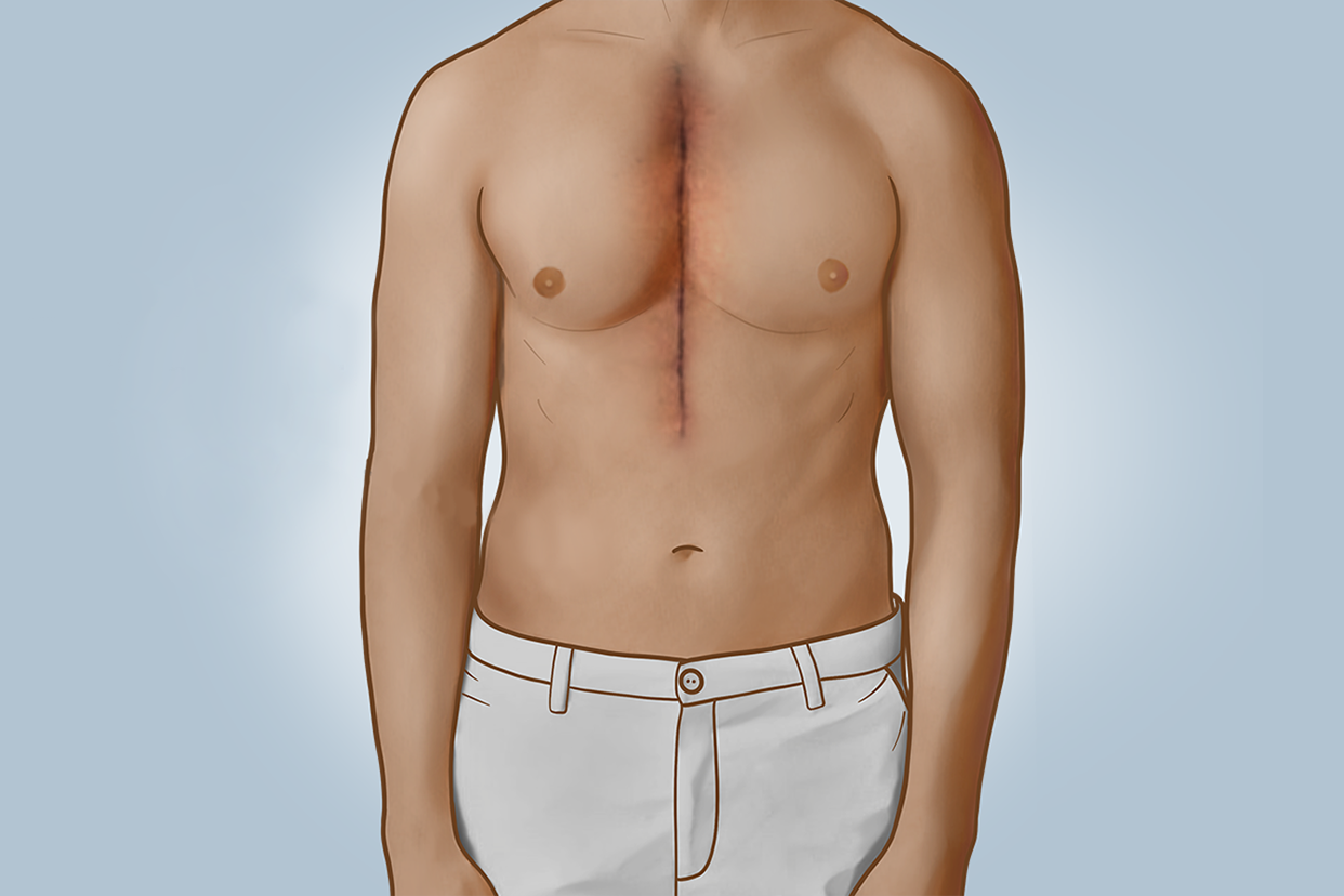 开胸手术拆线后伤口图片