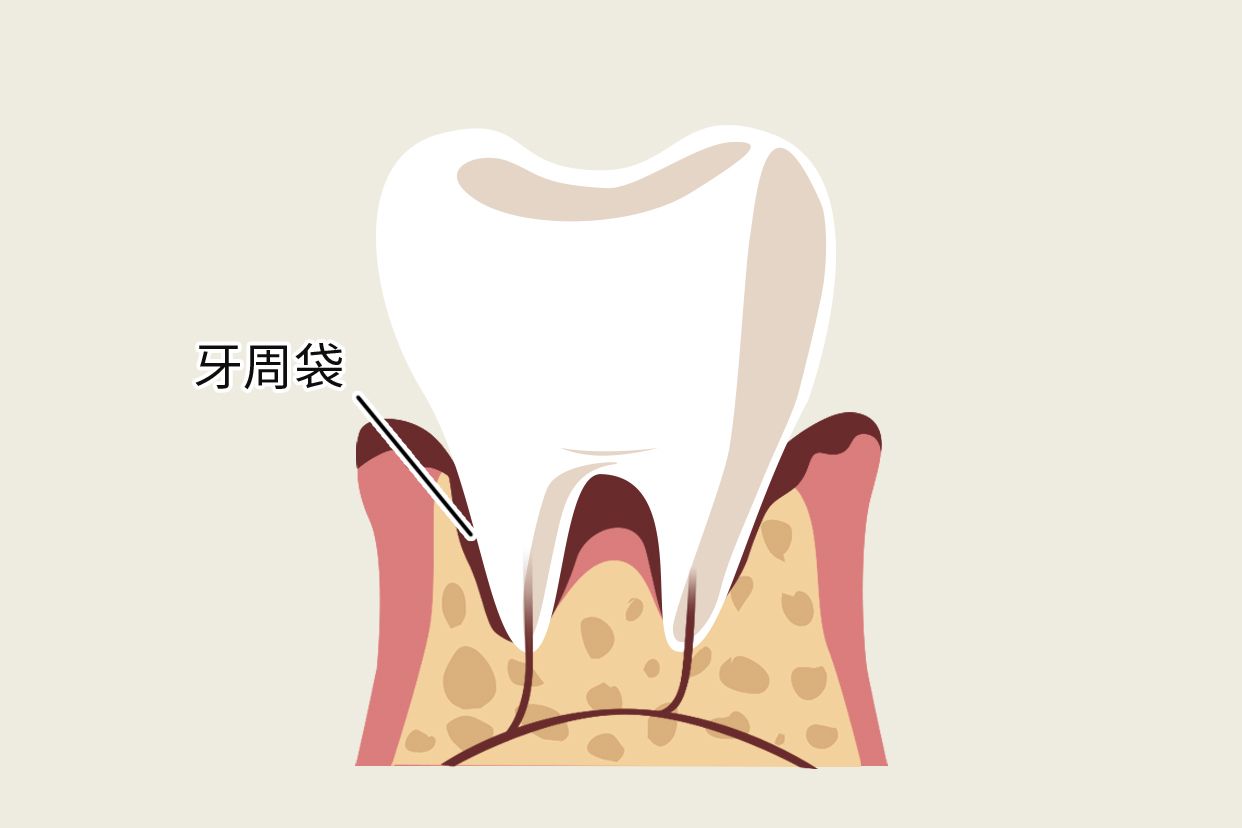 深牙周袋圖片