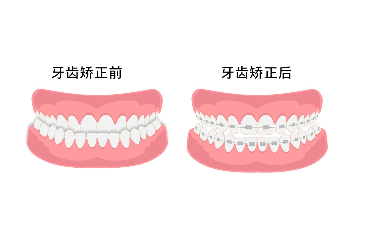 反颌牙齿矫正过程图片