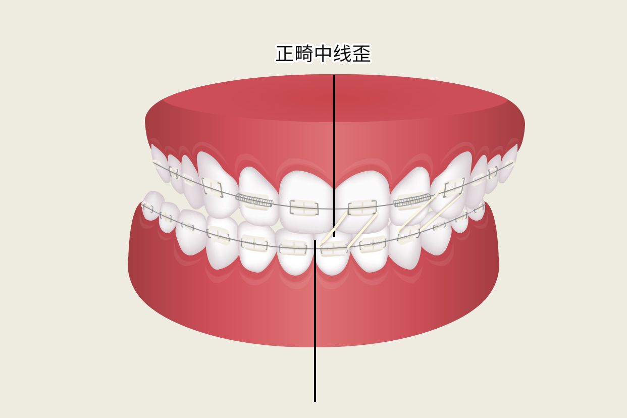 正畸中線歪如何牽引示意圖