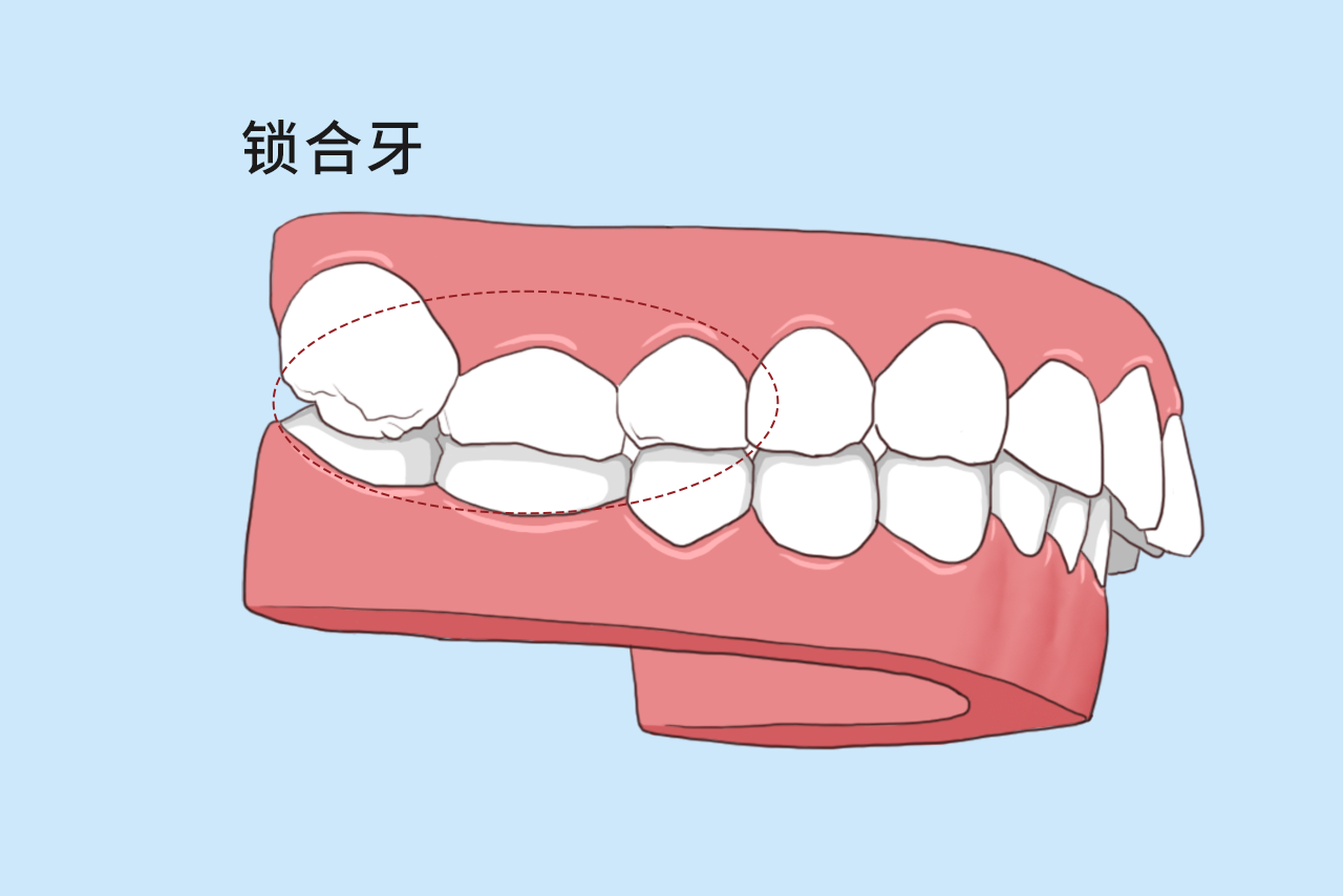 鎖合牙圖片