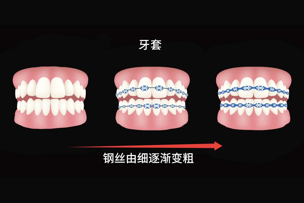 牙套换钢丝粗细顺序图片