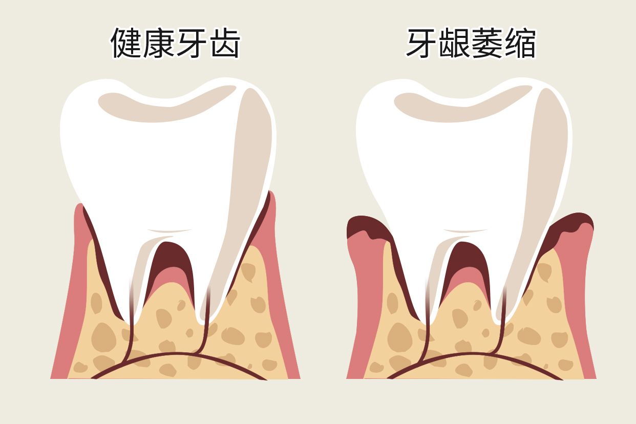 單個牙齦萎縮圖片