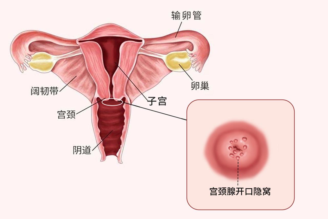 宫颈腺开口隐窝图片 正常宫颈醋酸白的照片