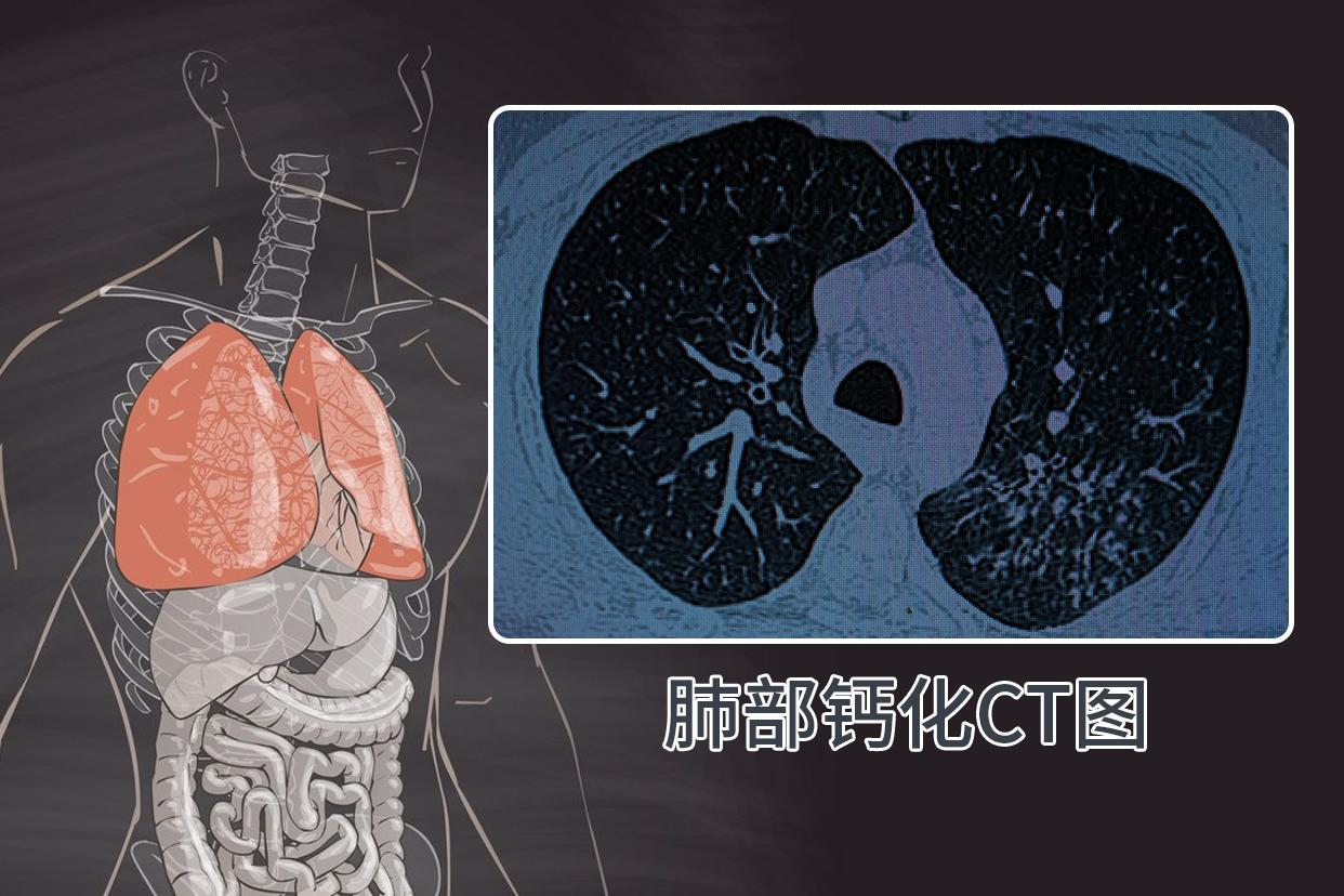 肺部钙化ct图像啥样的（肺部钙化灶ct图片）