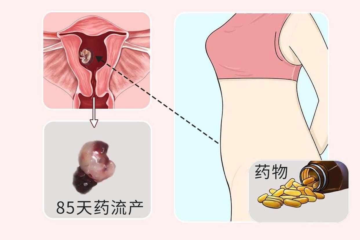 85天藥流產(chǎn)圖片（八十天藥流流下來圖片）