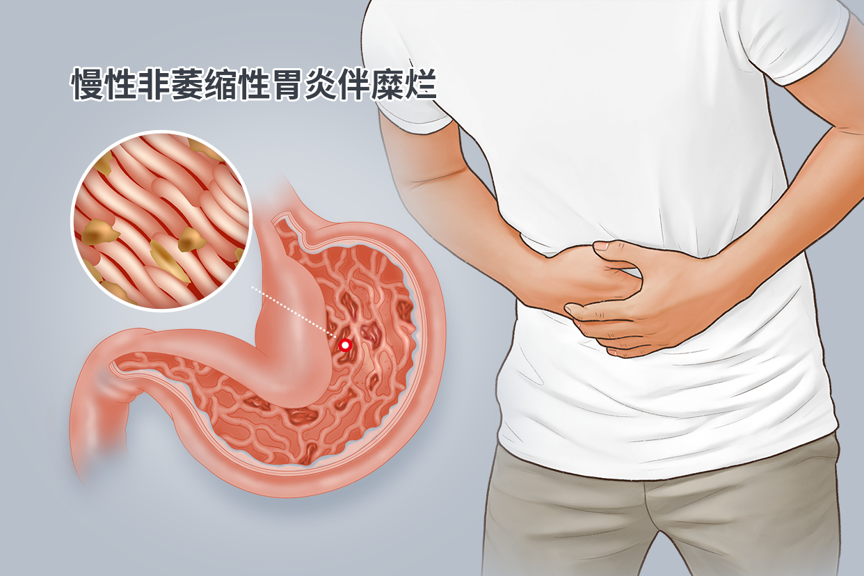 慢性非萎缩性胃炎伴糜烂图片 慢性非萎缩性胃炎伴糜烂图片攀枝花