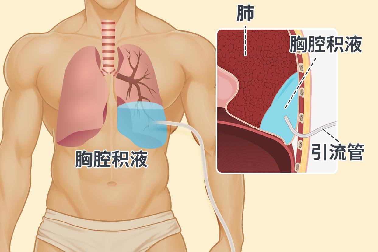 胸膜炎伤口引流管的位置图片（胸膜炎引流疼吗）