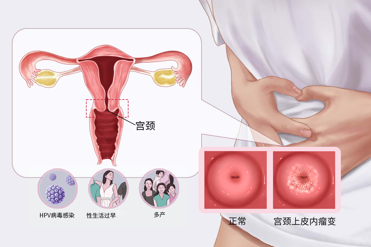 宫颈瘤样病变图片 宫颈瘤样病变严重吗