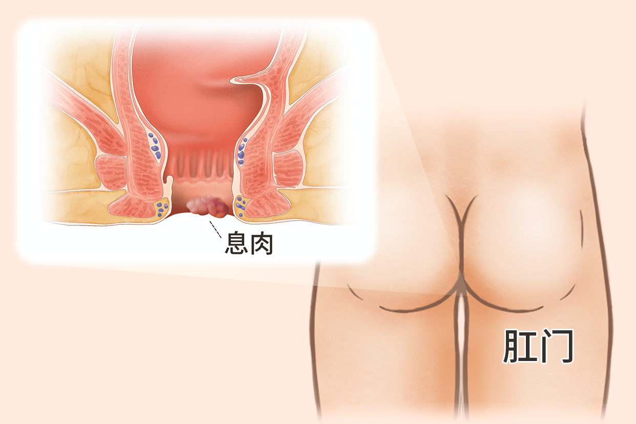 肛门肠息肉图片（肛门肠道息肉）