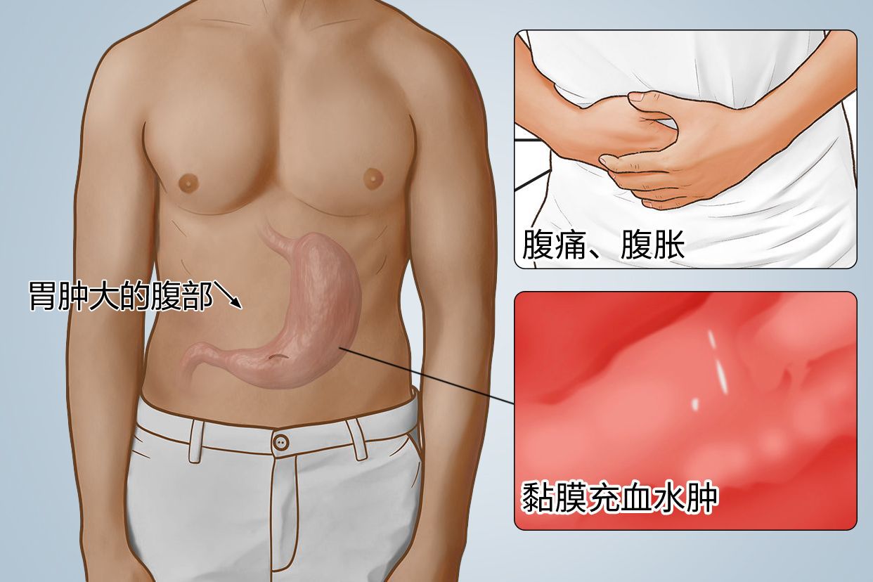 胃肿大的腹部图片（胃肿大的腹部图片大全）