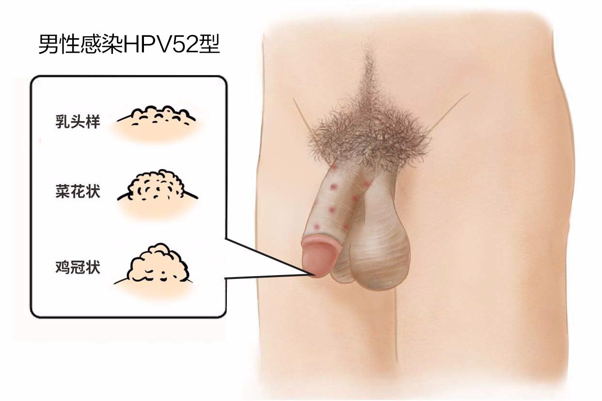 hpv52疣体长什么样 hpv52阳性疣体一般长在哪里