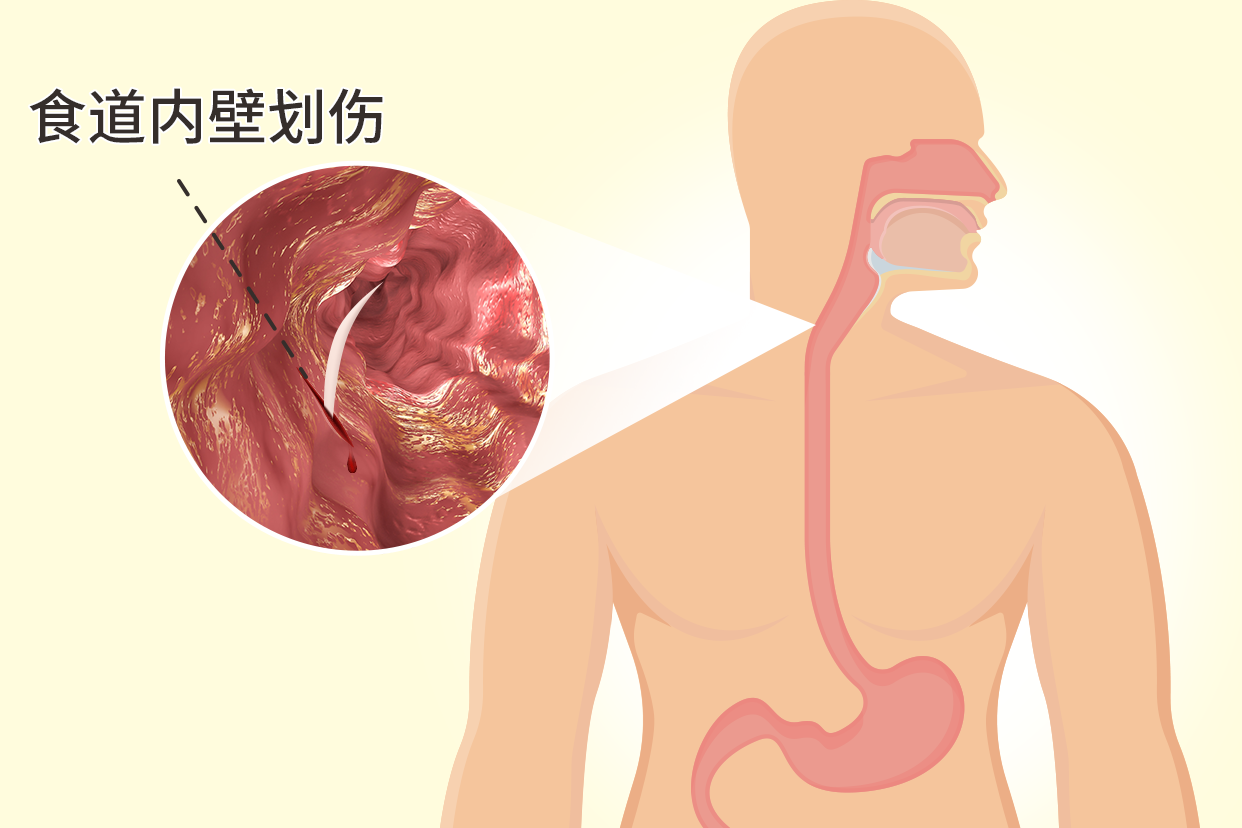 食道划伤图片 怎么判断食道划伤