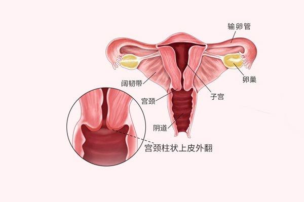 宫颈口外翻是怎么回事图片（宫颈口外翻如何治疗）