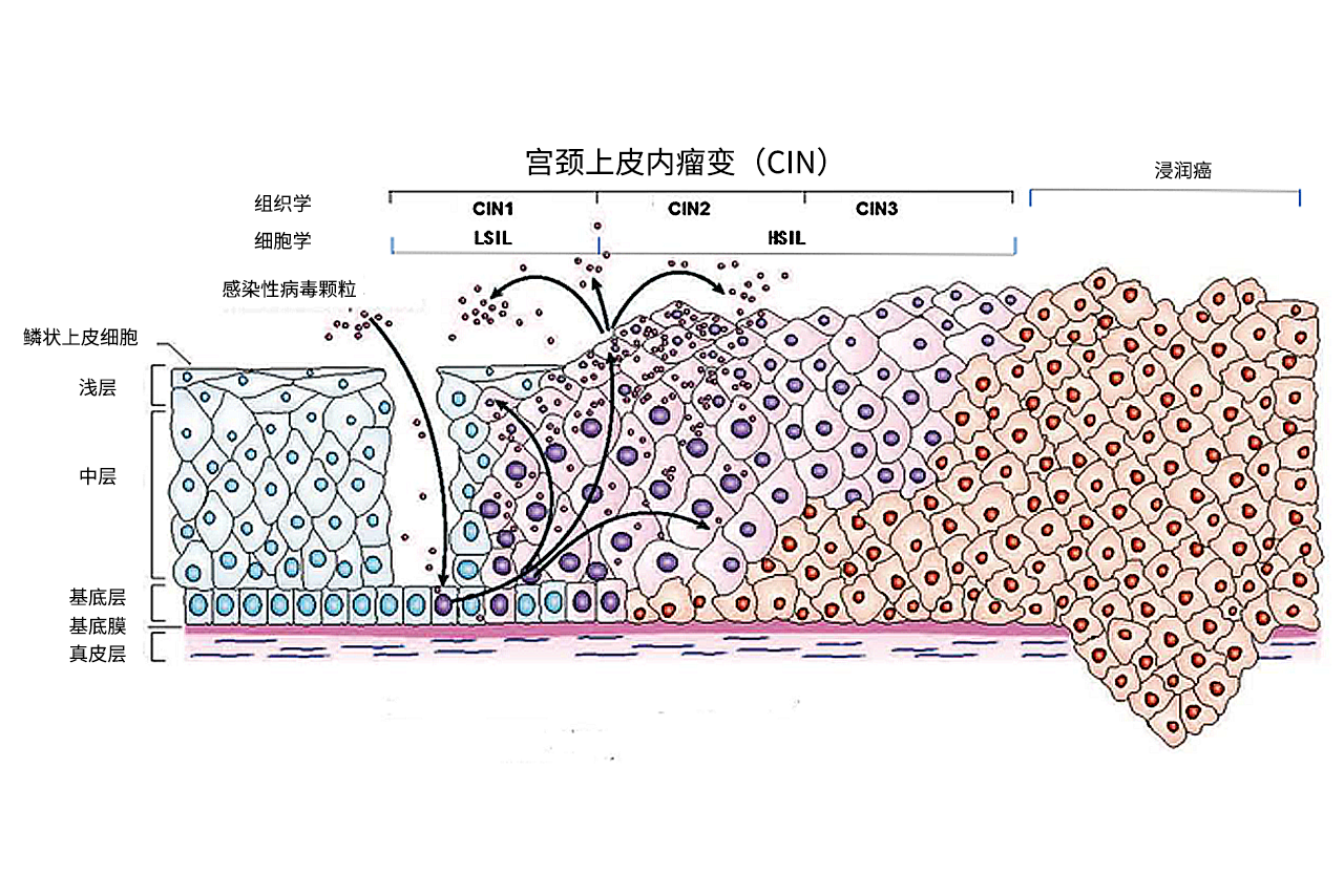 宫颈cin分级图片（宫颈cin级别是怎么回事）