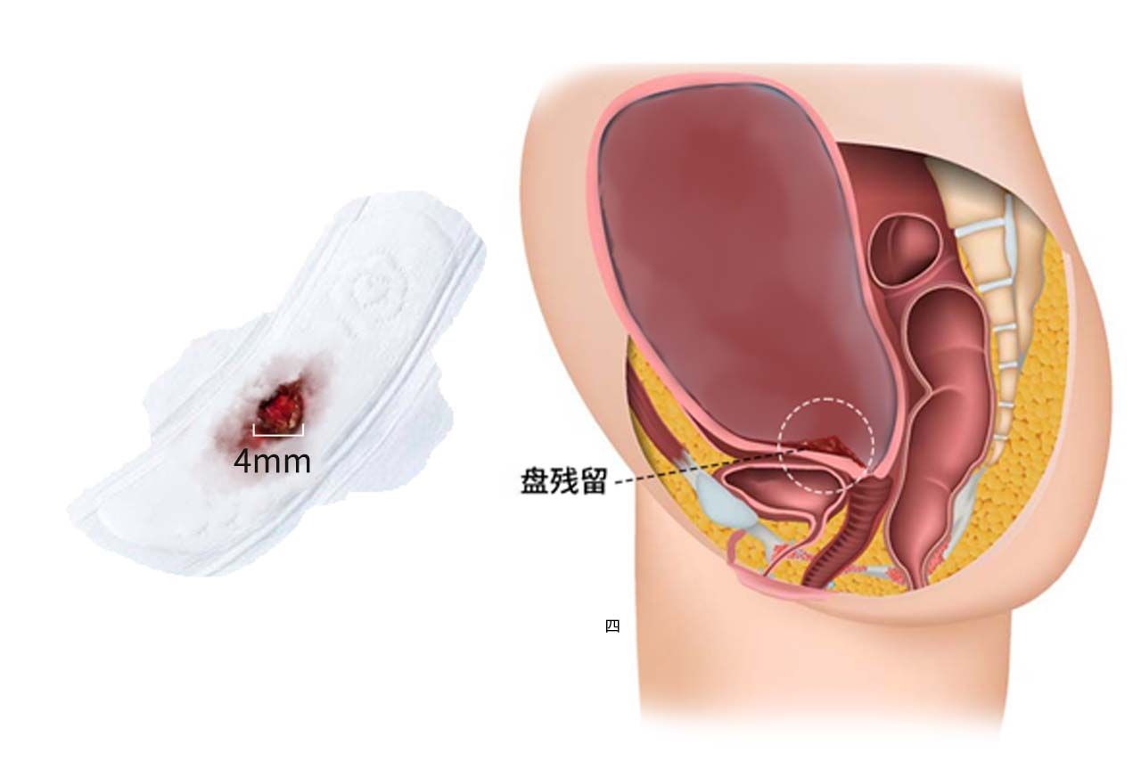 排出的残留物4mm的图片 排出的残留物是什么样子