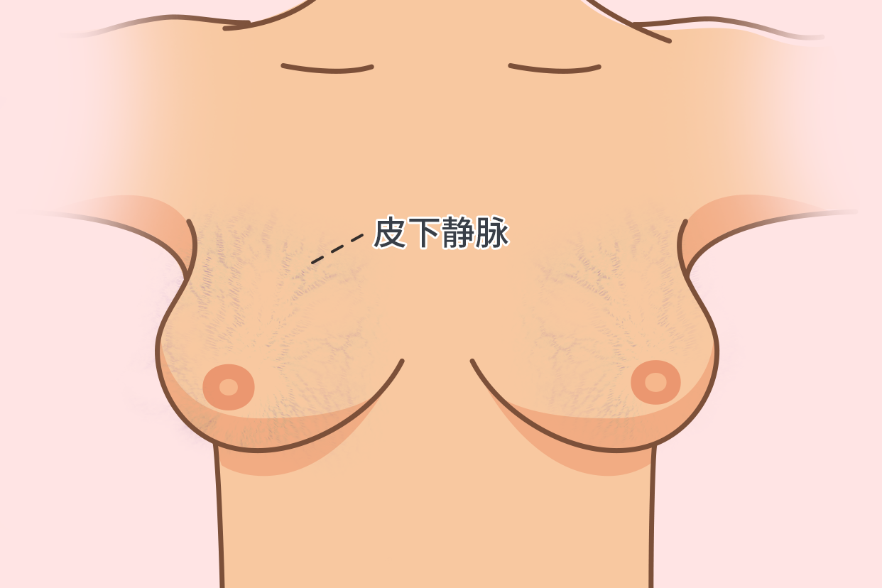 乳房皮下静脉图片 乳房皮下浅静脉血栓