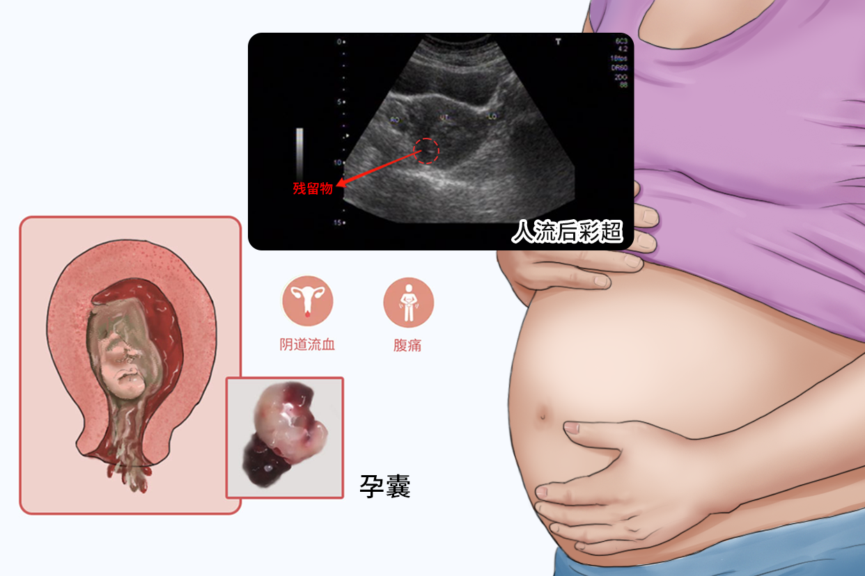 人流后有残留彩超图片 人流后有残留物b超是显示什么