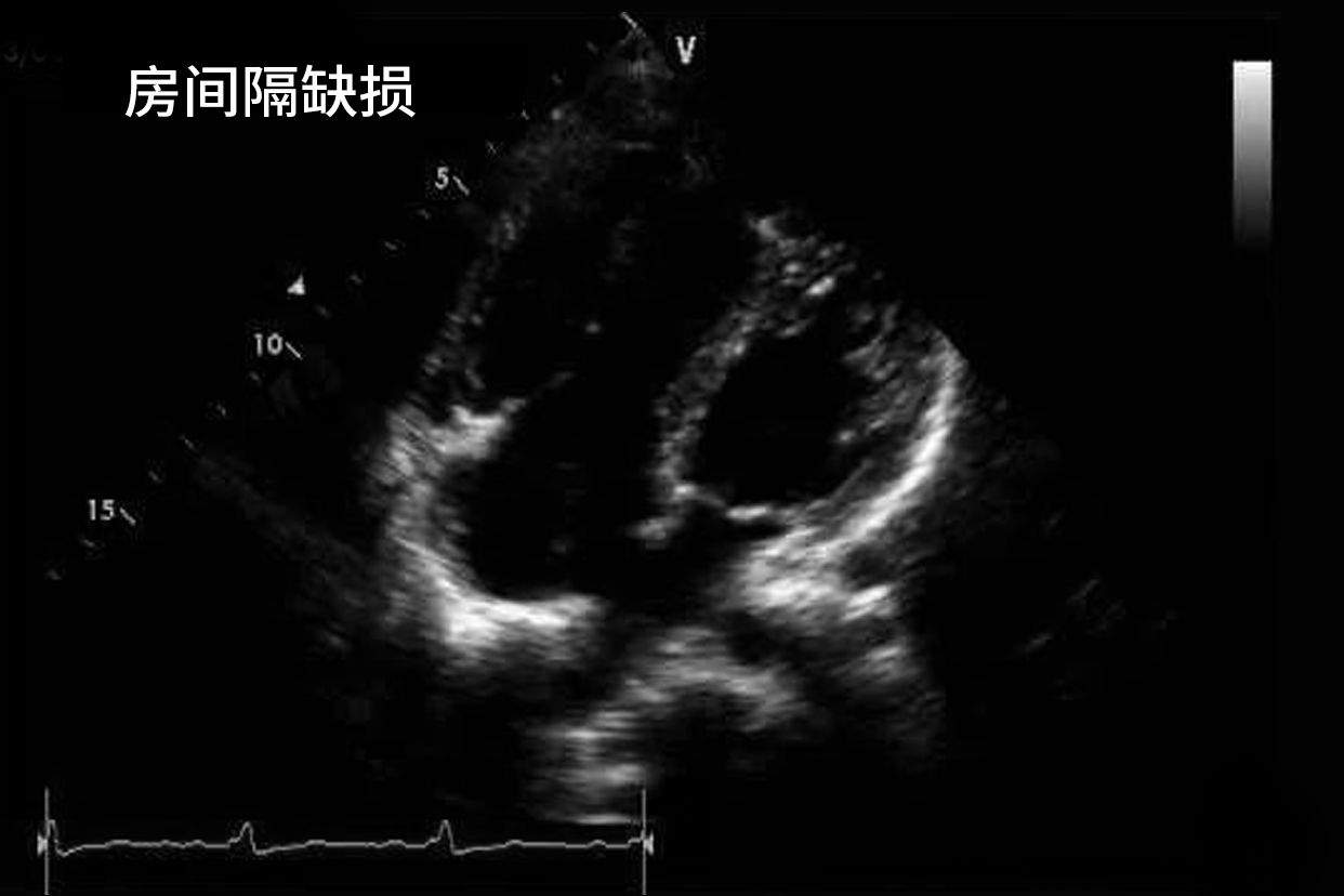 房间隔缺损超声心动图的特征 房间隔缺损超声描述