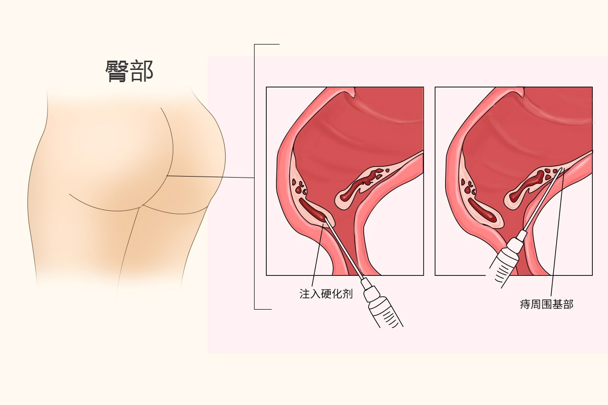 痔瘡打針后一個星期后圖片（痔瘡打針后一個星期了還流血）