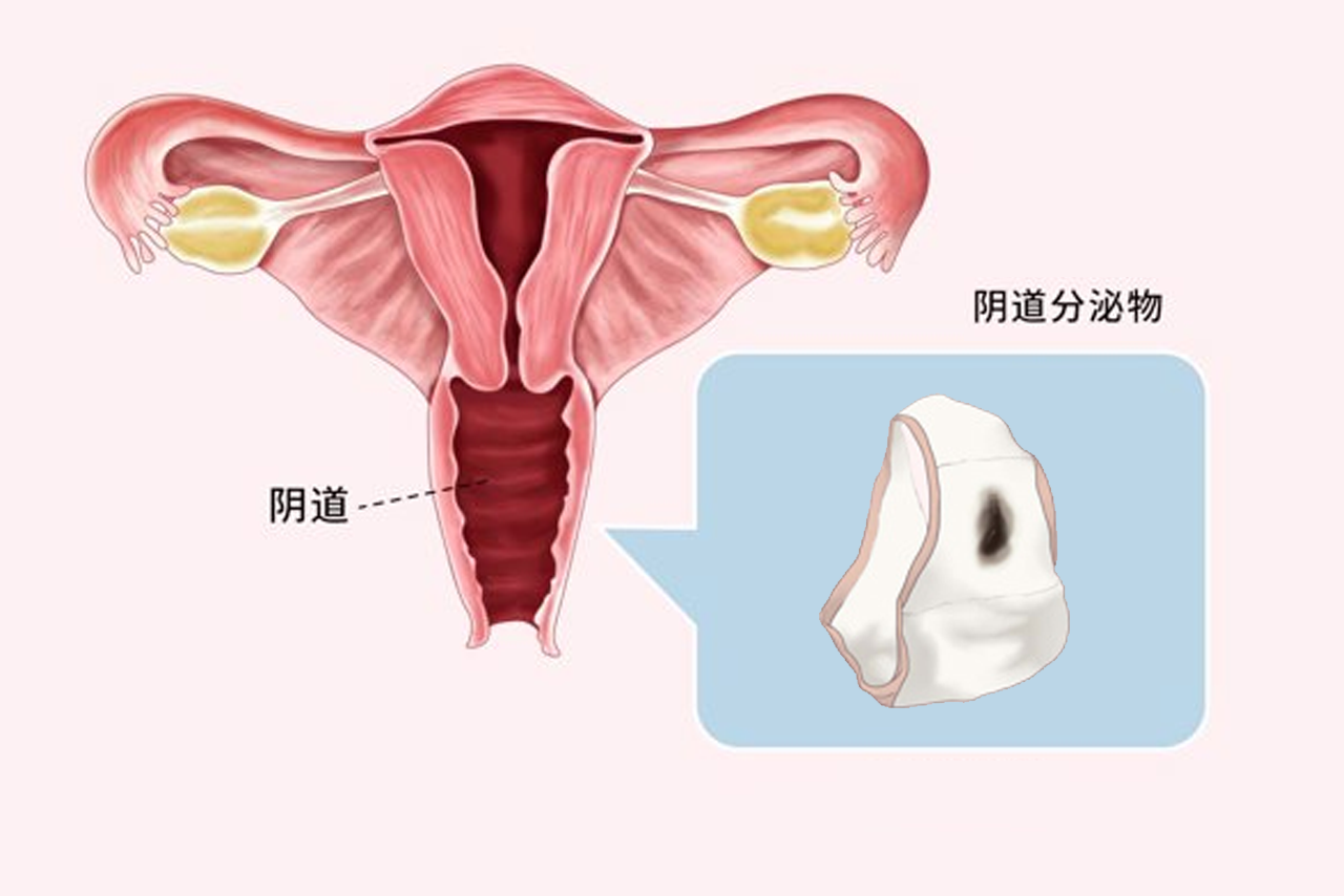 陰道里怎么會(huì)有黑色的分泌物圖片