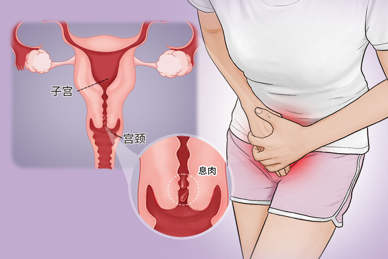 宮頸旁邊有息肉圖片（宮頸息肉旁邊的小疙瘩是什么）