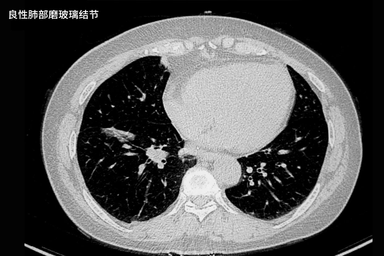 良性肺部磨玻璃结节影像图（良性磨玻璃结节的影像特征）