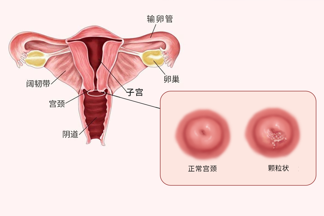 宫颈糜烂颗粒状图片 宫颈糜烂颗粒状是几度