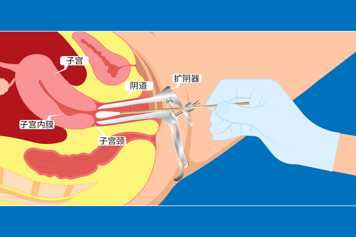 擴陰器陰道上藥圖片