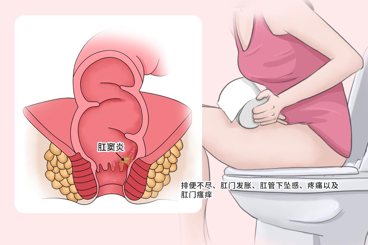 女性肛窦炎的症状图片 怎么判断是不是肛窦炎