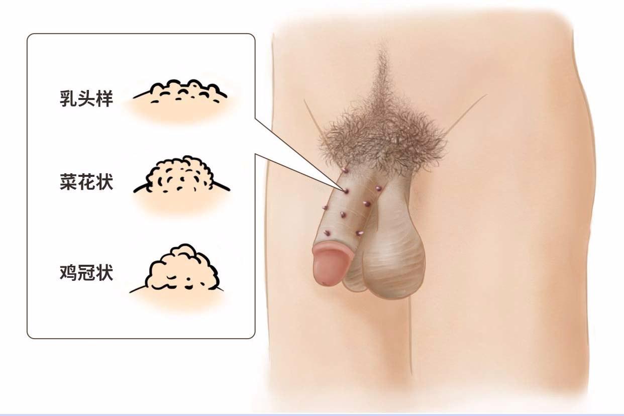 hpv6疣體長(zhǎng)什么樣（hpv6型疣體什么樣子）