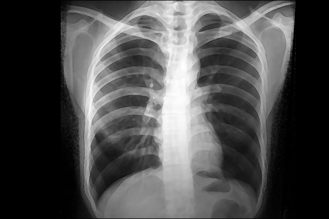 ct照片肺上有透亮影是什么 肺部透亮影一定是肺气肿吗