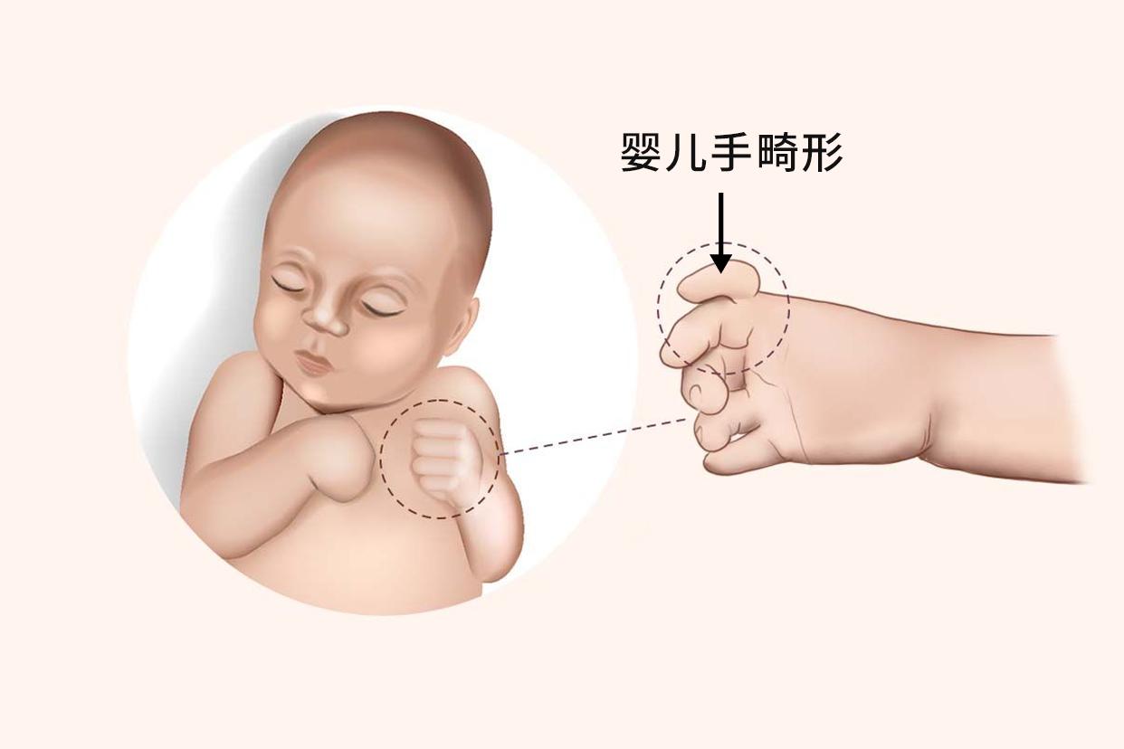 婴儿手畸形图片 婴儿手畸形可以恢复吗