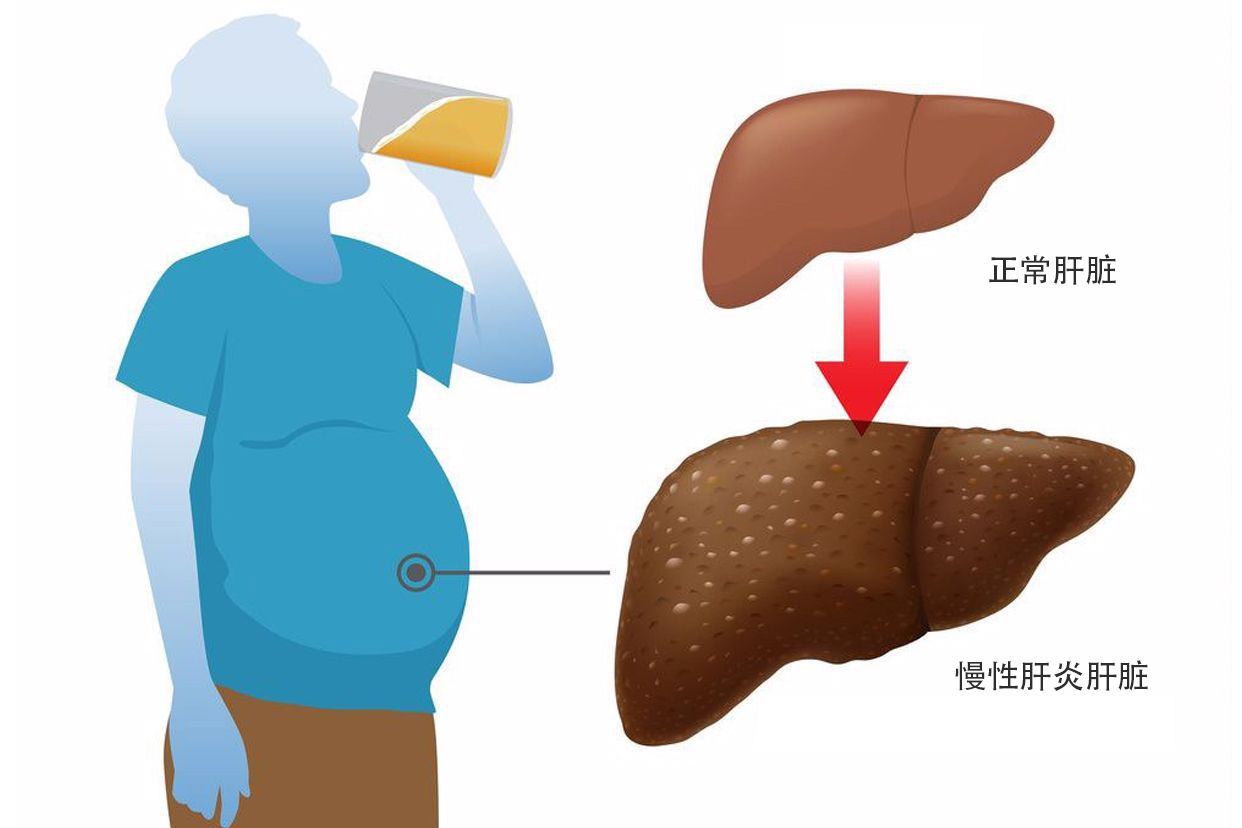 慢性肝炎图片（慢性肝病图片）