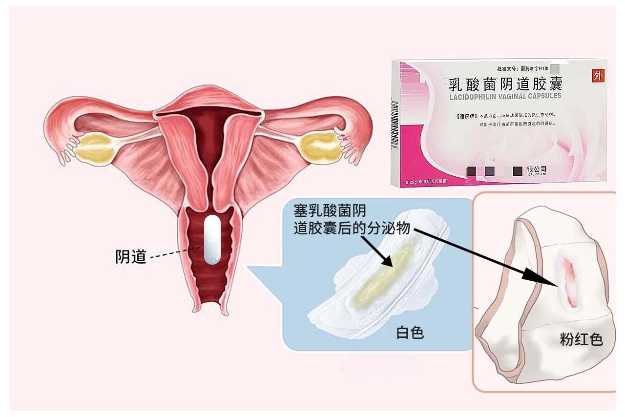 塞乳酸菌后的分泌物圖片 塞乳酸菌多久有效果嗎