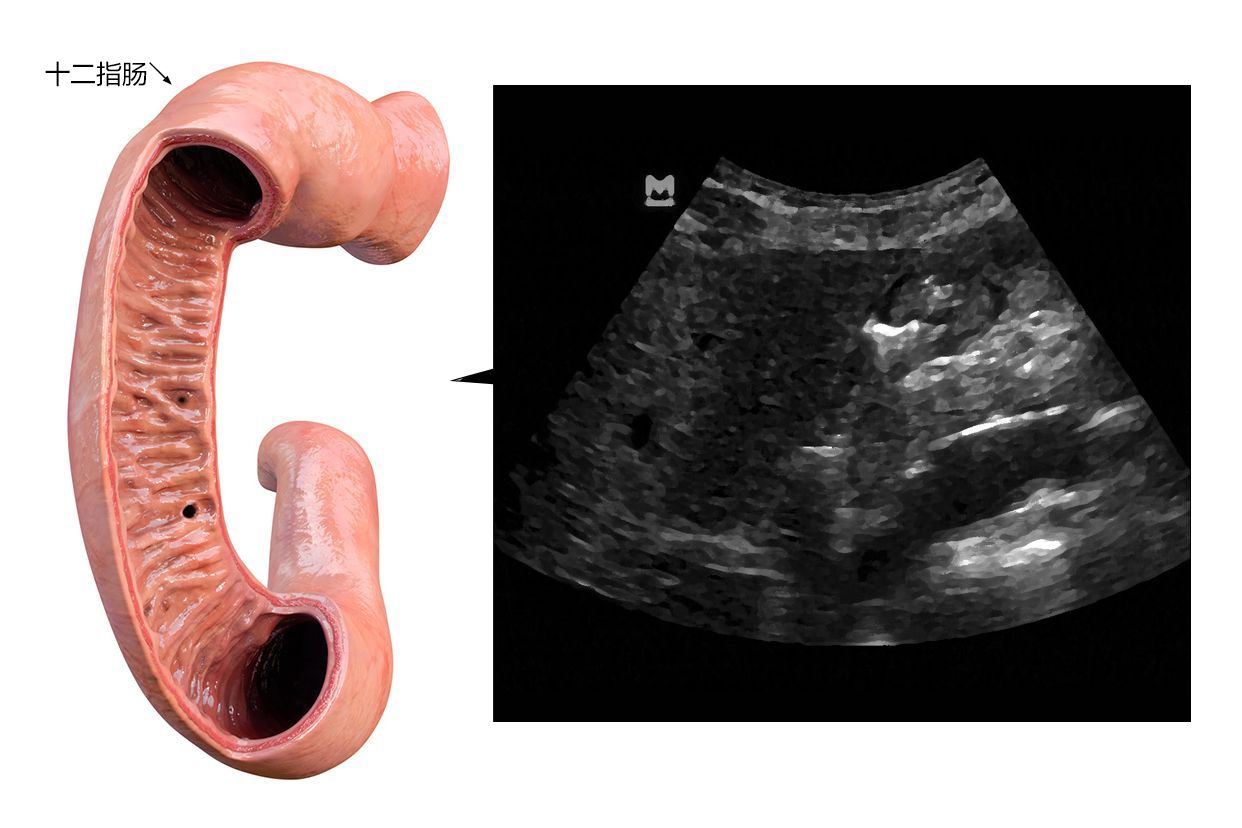 十二指肠超声图像（十二指肠超声检查）