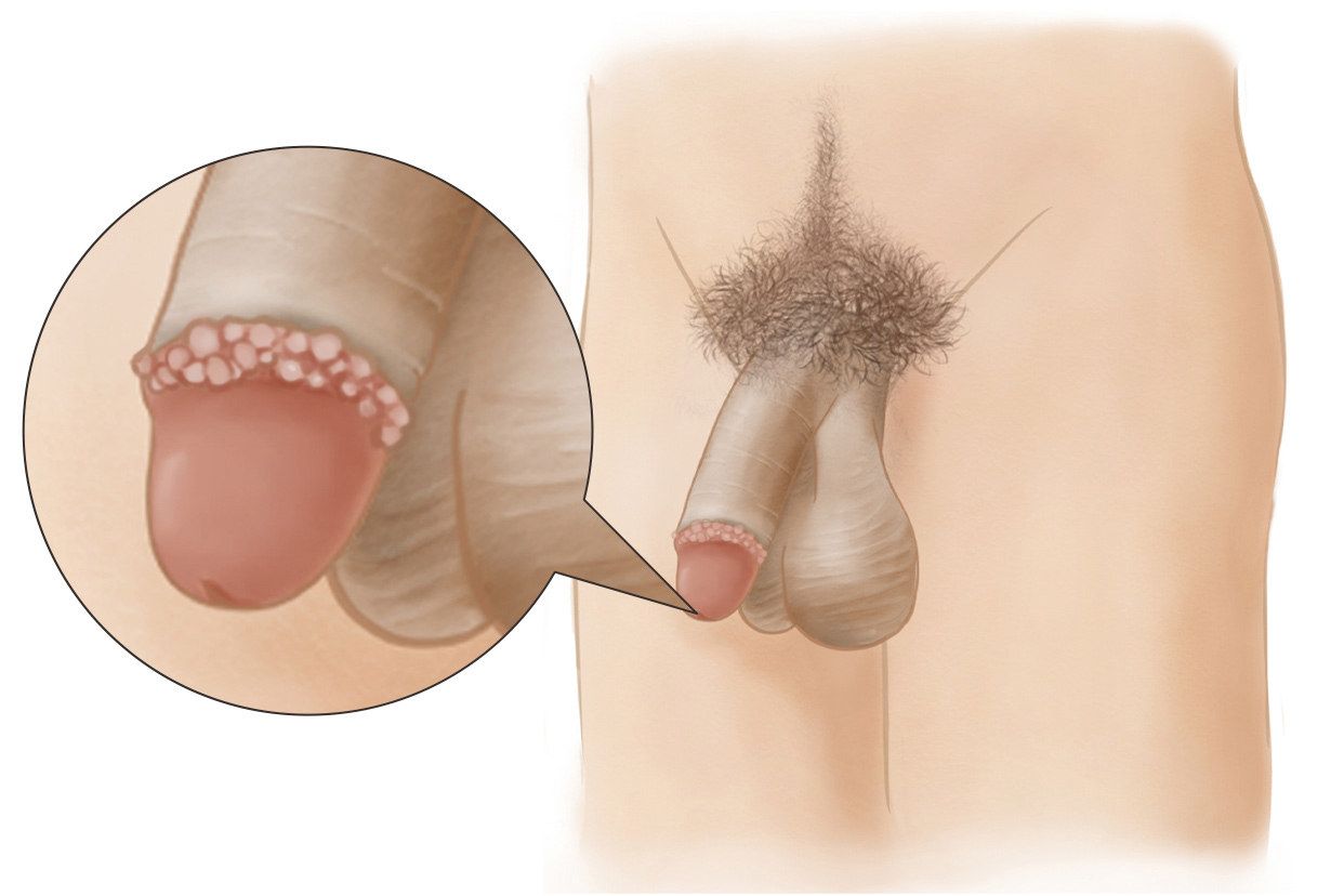 尖锐湿疣感染，小便位置的图片 尖锐湿犹小便的时候疼