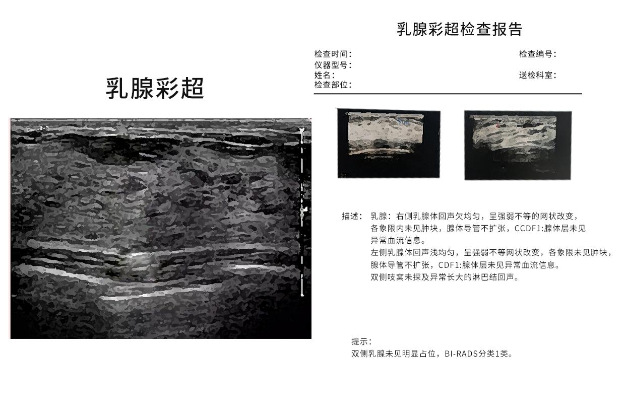 乳腺彩超报告看图片还是看结果 乳腺彩超报告看图片还是看结果准确