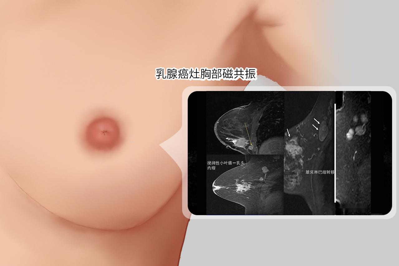 乳腺癌灶胸部磁共振图片（乳腺癌灶胸部磁共振图片）