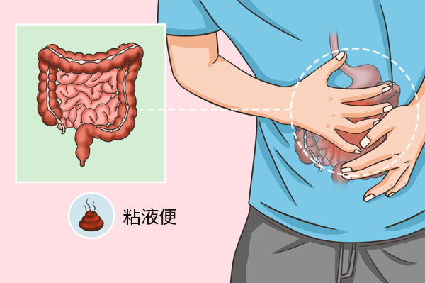 潰瘍性結(jié)腸炎粘液便圖片（潰瘍性結(jié)腸炎拉粘液便是不是很嚴重）